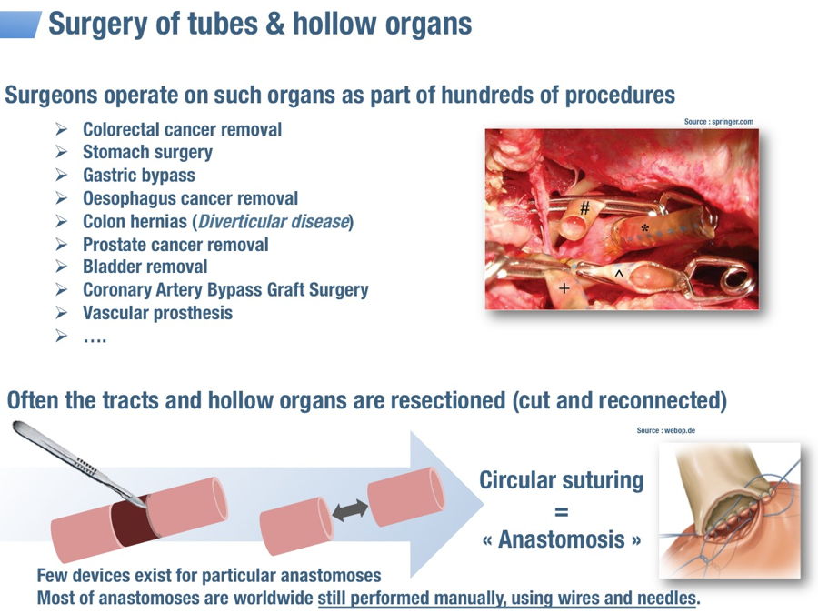 Surgery of tubes and hollow organs. Surgeons operate on such organs as part of hundreds of procedures : colorectal cancer, stumach surgery, gastric bypass, prostate cancer removal, bladder removal, vascular prosthesis. Circular suturing = anastomosis.