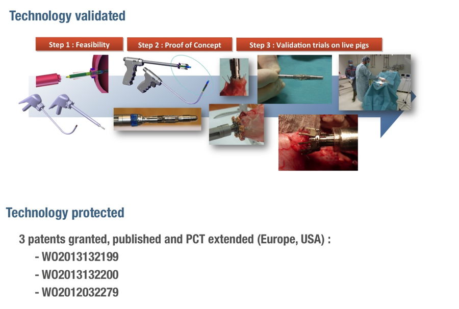 Uroloink designed for prostate cancer surgery - radical prostatectomy. Six separate stiches, mucosal side-by-side reconnexion, natural healing of the tissues, resorbable sutures.